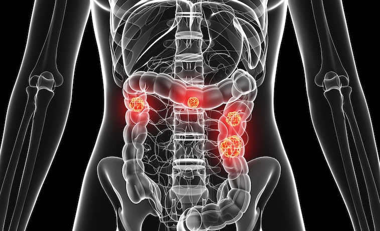 MRI image depicting colon cancer