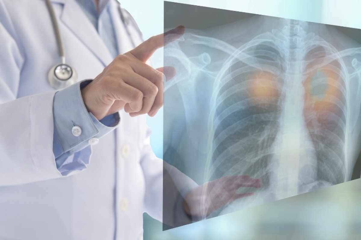 doctor holds image of lungs